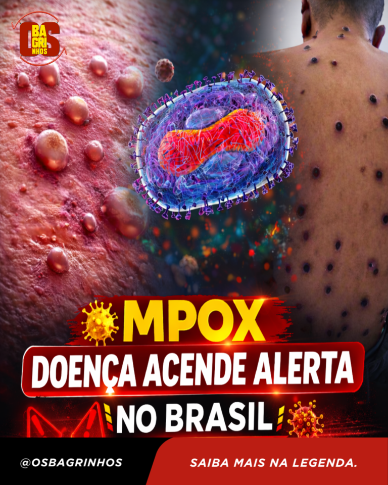 MPOX: DOENÇA ACENDE ALERTA NO BRASIL COM MAIS DE 80 CASOS CONFIRMADOS
